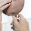 Understanding Genetics and Male Pattern Baldness