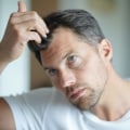 Hormonal Imbalances and Hair Loss: Causes, Treatment, and Prevention