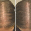 Medical Treatments for Female Hair Loss