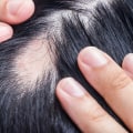Understanding Medical Conditions and Female Hair Loss