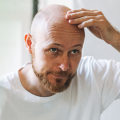 Lifestyle Factors and Male Pattern Baldness: Understanding the Causes and Finding Solutions