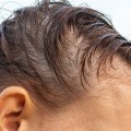 Understanding Vitamin D for Hair Growth