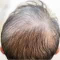 Vitamin C for Hair Health: The Key to Preventing Baldness and Promoting Hair Growth