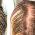 Pregnancy and Postpartum Hair Loss: Causes, Prevention, and Treatment