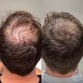 Stress Management for Hair Health: Tips and Techniques to Prevent Baldness and Promote Hair Regrowth