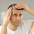 Understanding Minoxidil for Hair Loss: The Ultimate Guide