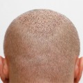 Exploring Hair Transplants: Understanding Causes, Treatments, and Solutions