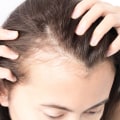 Lifestyle Factors and Female Hair Loss: Understanding the Causes, Prevention, and Treatment