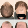 All You Need to Know About Medical Treatments for Male Pattern Baldness