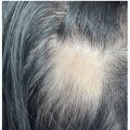 Thyroid Disorders and Hair Loss: Understanding the Connection