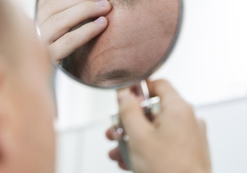 Understanding Genetics and Male Pattern Baldness