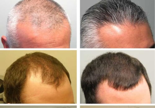 How Finasteride Can Help Prevent Baldness and Restore Hair Growth