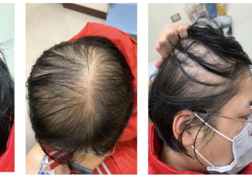 Diagnosing Female Hair Loss: Understanding Causes and Treatment Options
