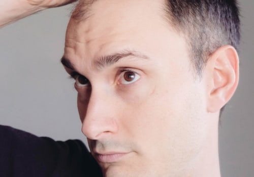 Lifestyle Changes for Preventing Male Pattern Baldness: A Comprehensive Guide