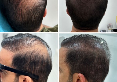 Discover the Secrets of Scalp Camouflage Techniques