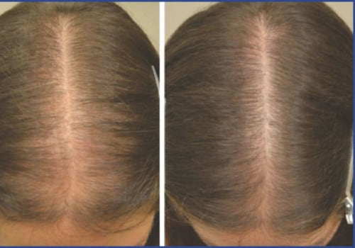 Medical Treatments for Female Hair Loss