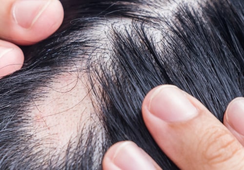 Understanding Medical Conditions and Female Hair Loss
