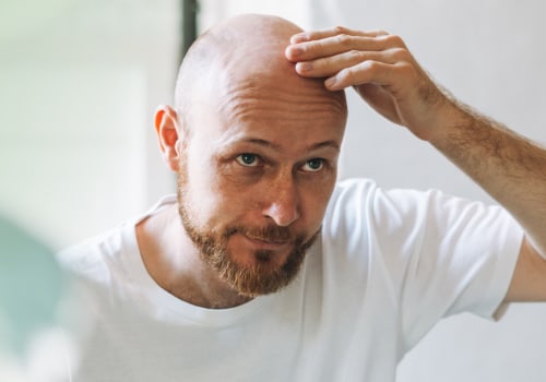 Lifestyle Factors and Male Pattern Baldness: Understanding the Causes and Finding Solutions