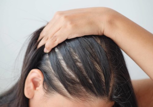 Hairstyles for Thinning Hair: Solutions and Treatments to Prevent Baldness or Hair Loss