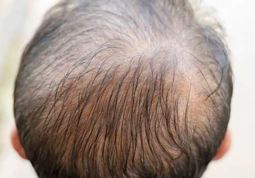 Vitamin C for Hair Health: The Key to Preventing Baldness and Promoting Hair Growth