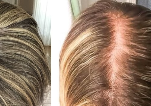 Pregnancy and Postpartum Hair Loss: Causes, Prevention, and Treatment