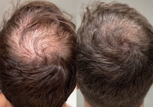 Stress Management for Hair Health: Tips and Techniques to Prevent Baldness and Promote Hair Regrowth
