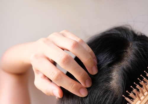 Understanding Iron-Deficiency Anemia and Hair Loss