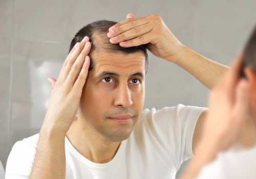 Understanding Minoxidil for Hair Loss: The Ultimate Guide