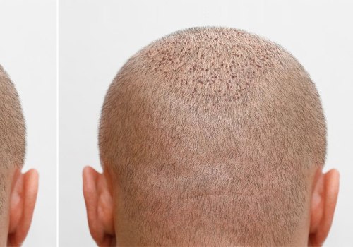 Exploring Hair Transplants: Understanding Causes, Treatments, and Solutions
