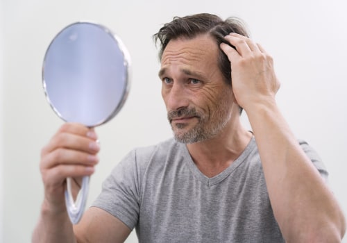 Understanding Alopecia: Causes, Prevention, and Treatment