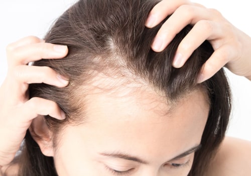 Lifestyle Factors and Female Hair Loss: Understanding the Causes, Prevention, and Treatment