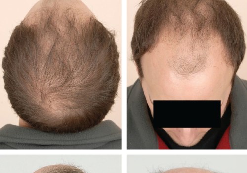 All You Need to Know About Medical Treatments for Male Pattern Baldness