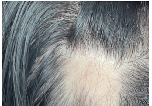 Thyroid Disorders and Hair Loss: Understanding the Connection