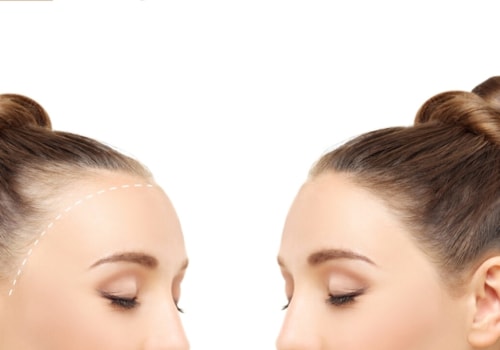 Hair Loss: Prevention and Management for Women